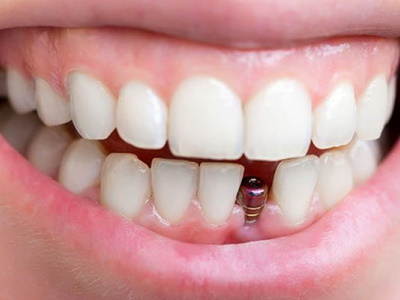 Имплант зуба Osstem с коронкой: цена в Мурманске