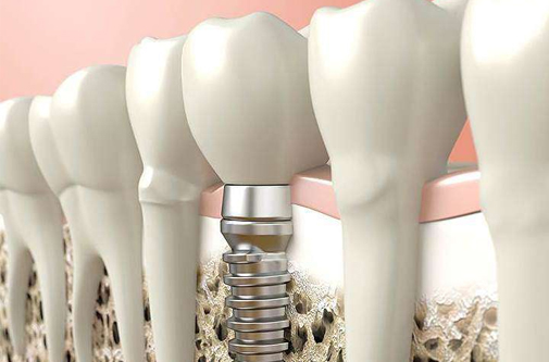 Установка импланта зуба: этапы, цены в Мурманске
