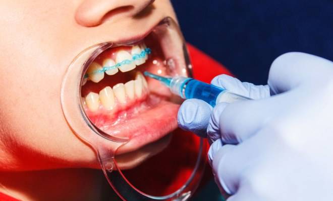 Реминерализация и фторирование зубов: показания, стоимость в Мурманске