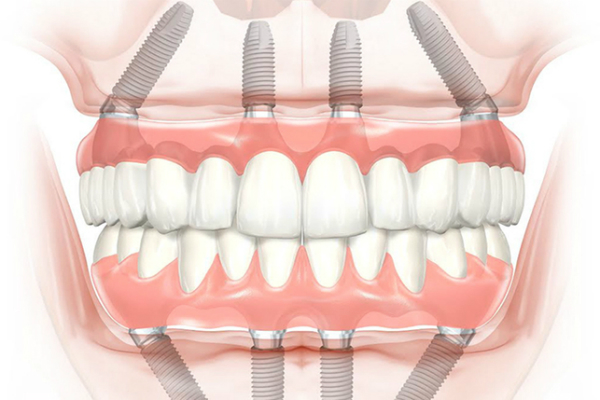 Имплантация зубов на 4 имплантах в Мурманске