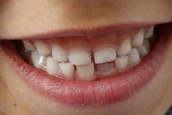 Удлинение клинической длины зубов: показания, особенности проведения