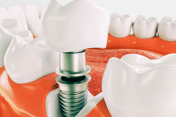 Сколько стоит имплантация зубов: цена услуги в Мурманске