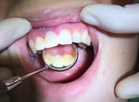Лечение зубов в Мурманске