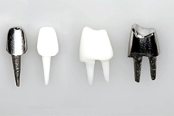 Восстановление зуба культевой вкладкой в стоматологии в Мурманске